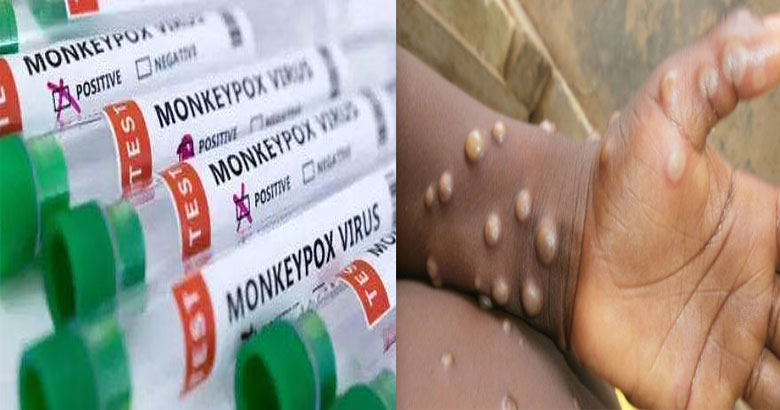 kerala monkey pox| bignewskerala